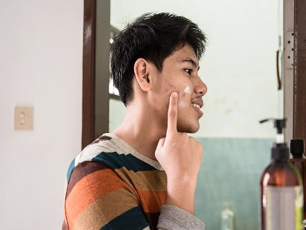 Teenager applying acne cream