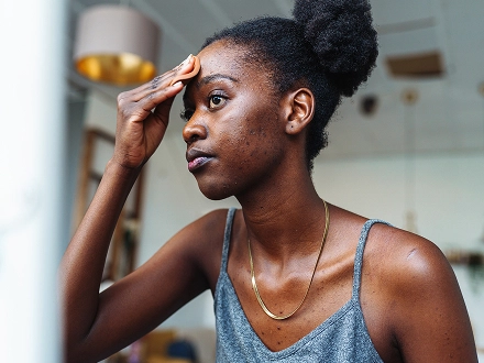 Woman applying cream for acne
