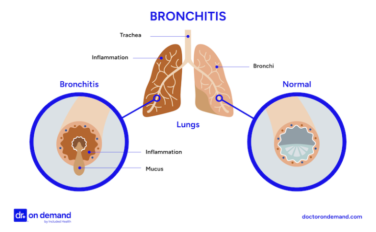 When to See a Doctor for Chest Congestion: When is it serious