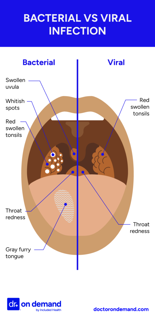 Bacterial infection vs Sinus Infection Image illustration of sore throat displaying the difference between bacterial and viral infection.