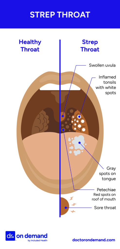 Illustration of healthy throat vs strep throat