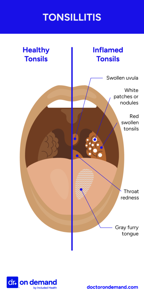 Health tonsils vs inflamed tonsils Illustration of open mouth showing healthy tonsils vs inflamed tonsils