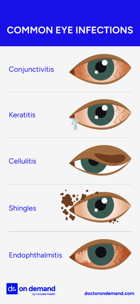 A medical illustration showing five different eye infections. From top to bottom, the eyes are labeled with their conditions: "Conjunctivitis" (red, irritated eye), "Keratitis" (eye with a tear and red irritation), "Cellulitis" (eye with a swollen upper eyelid), "Shingles" (eye with brown spots around it), and "Endophthalmitis" (a severely inflamed and red eye). By Doctor On Demand.