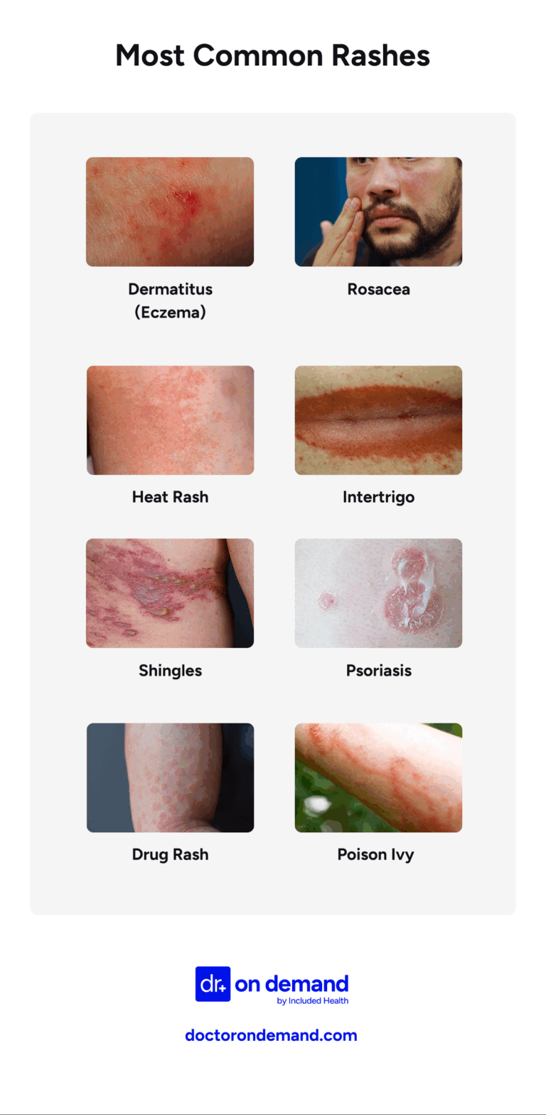 Retiform Rash When to go to Urgent Care for Rash: When is a Rash Serious?