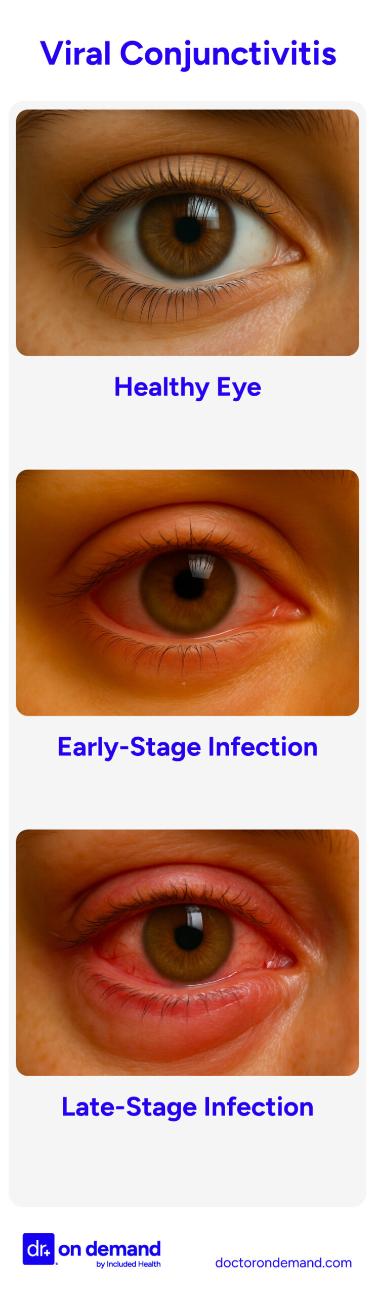 Healthy eyes compared to stages of pink eye