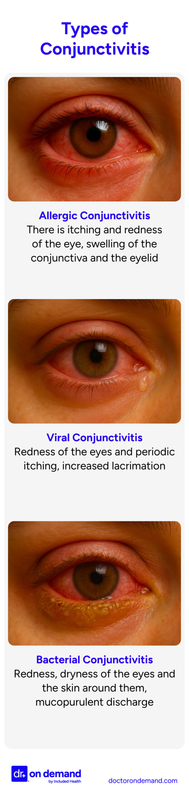 Various types of conjunctivitis