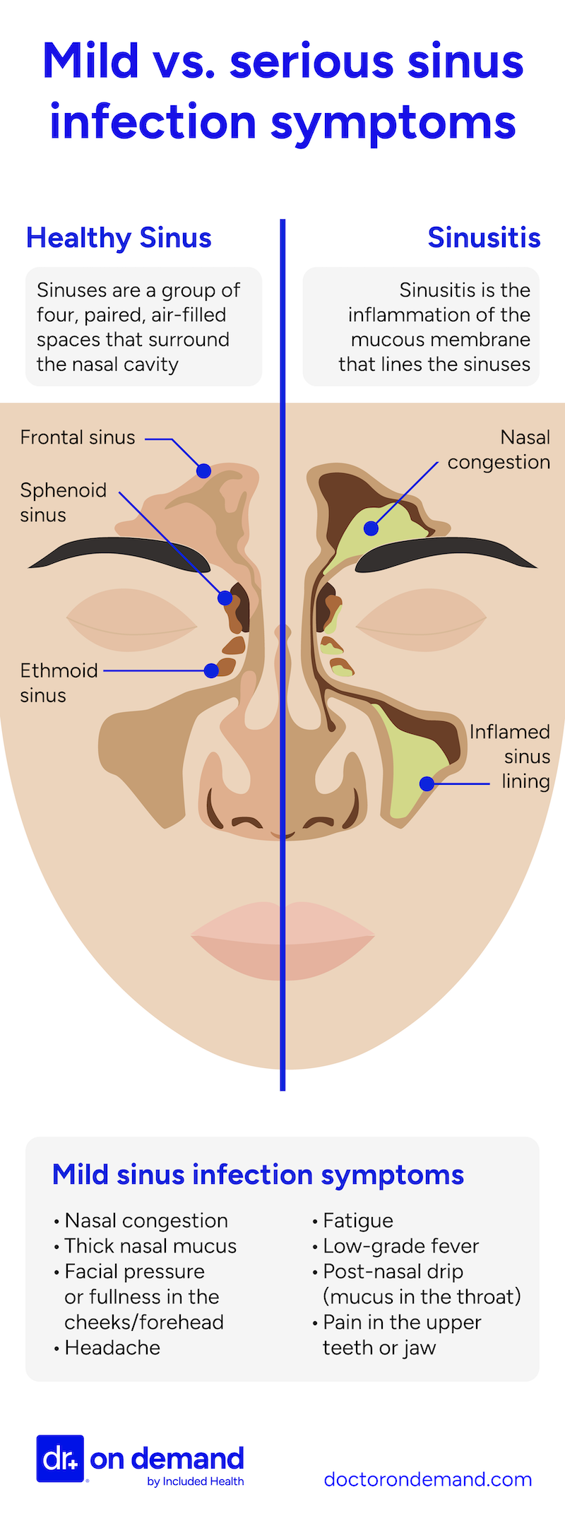 Mild vs. serious sinus infection symptoms